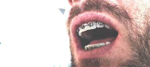 Braces @braces cover picture